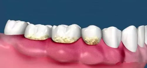 齦下刮治和洗牙有何區別？什麼情況下需要齦下刮治？