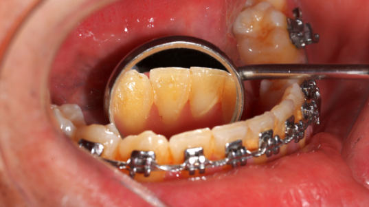 牙齒矯正容易有蛀牙嗎？