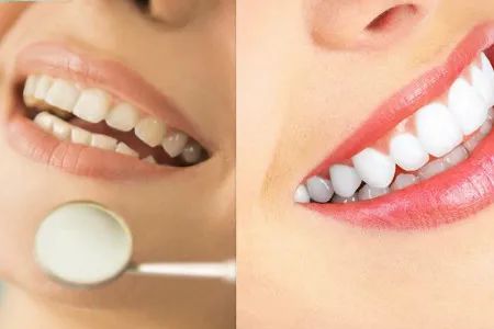 五類行爲會損害牙齒健康！
