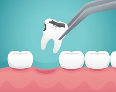 tooth-extraction-illustration-260nw-1305962044